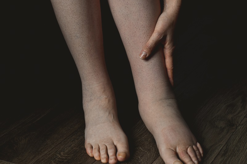 Close-up of a woman's hand on her swollen ankle who needs leg pain treatment in Venice, FL