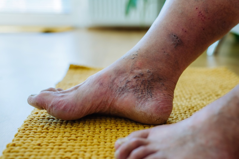 close shot of a man's foot and ancle with venous ulcers starting before recieving Vein Treatment near Laurel, FL