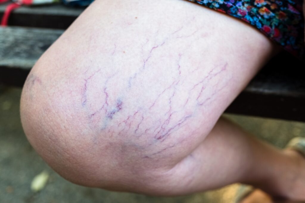 closeup shot of woman's leg as she sits on a bench, showing spider veins before having Spider Vein Treatment near Laurel, FL